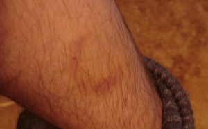 Two and a half weeks after a beam hit me while talking on the telephone. I seem to have been controlled to not look at it and later not photograph it until it was almost healed.