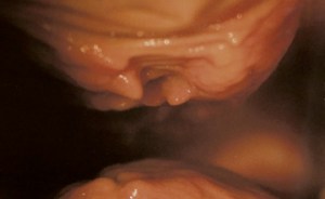 My g-spot (descending bulge) was sliced from back to front and twice more (not visible here) from side to side.