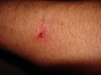 Taser burn (second degree burn with skin removed) delivered November 29, 2010, photographed 2 days later.