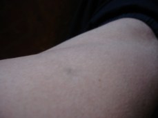 Small bruises on my thighs are the most common - making me think of hypodermic bruises (though I usually don't bruise from shots).  What are they?  Taser marks?