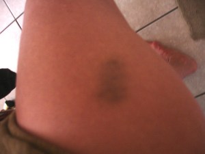 thigh bruise copy