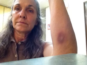 This bruise showed up ten days after another very similar showed up on the back of my leg.  No explanation except...