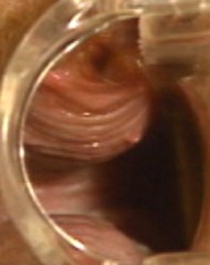 For comparison, here's a normal g-spot. The photograph was supplied by a friend in sex education. You can see it is ribbed and round.