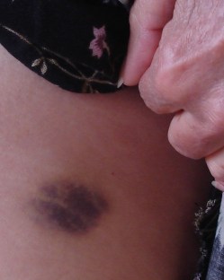 hip bruise 1 crop