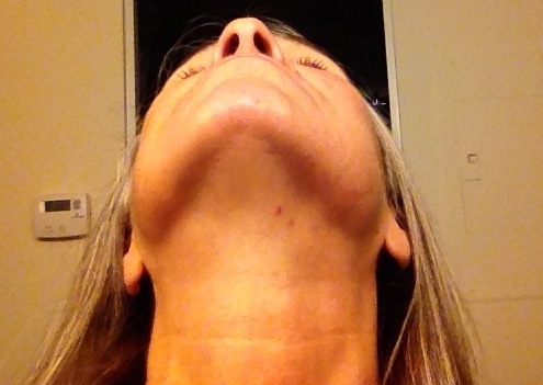 15-11-x vampire bite @ m d.jpg