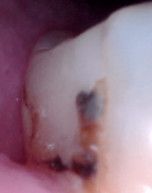 Back tooth low rt 2019-05-16 at 7.42.47 AM copy.png