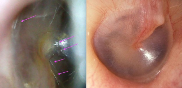 Two eardrums annotated 2019-06-26 at 6.40.21 AM copy.jpg