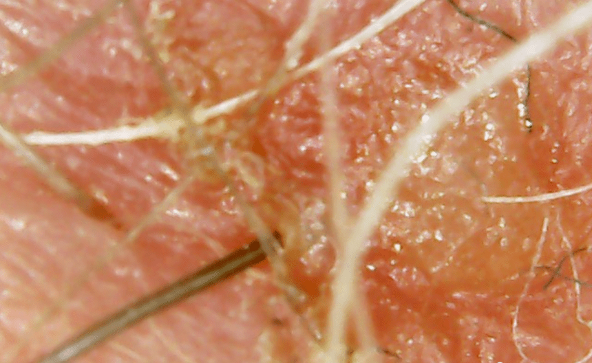 Lesion w worms 2019-08-06 at 8.00.26 AM.png