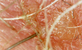 Lesion w worms 2019-08-06 at 8.00.26 AM 4w.png