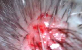 scalp ulcer 2019-10-08 at 3.35.36 PM copy.png